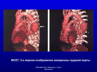 МСКТ. 3-х мерное изображение аневризмы грудной аорты MeduMed.Org -  Медицина - Наше Призвание 