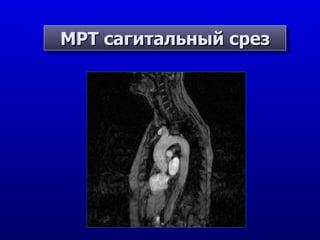 МРТ сагитальный срез 