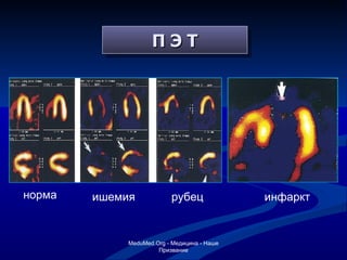 П Э Т инфаркт норма ишемия рубец MeduMed.Org -  Медицина - Наше Призвание 