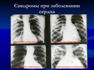 Синдромы при заболевании сердца Нормальная конфигурация Митральная   конфигурация Аортальная конфигурация Трапециевидная конфигурация 