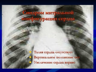 Синдром митральной конфигурации сердца Талия сердца отсутствует Вертикальное положение оси Увеличение сердца вправо 