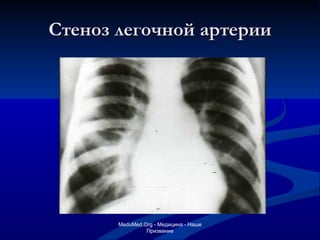 Стеноз легочной артерии MeduMed.Org -  Медицина - Наше Призвание 
