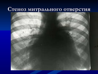 Стеноз митрального отверстия 