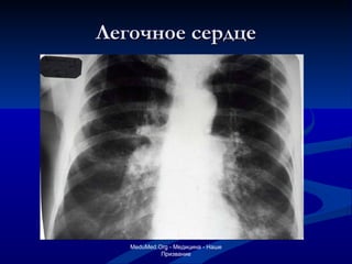 Легочное сердце MeduMed.Org -  Медицина - Наше Призвание 