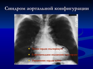 Синдром аортальной конфигурации Талия сердца подчеркнута Горизонтальное положение оси сердца Увеличение сердца влево 