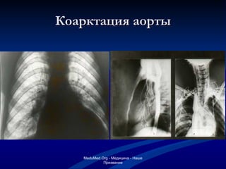 Коарктация аорты MeduMed.Org -  Медицина - Наше Призвание 