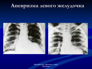 Аневризма левого желудочка MeduMed.Org -  Медицина - Наше Призвание 