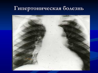 Гипертоническая болезнь 