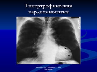 Гипертрофическая кардиомиопатия MeduMed.Org -  Медицина - Наше Призвание 