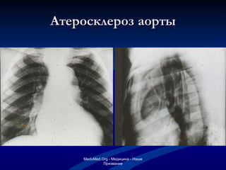 Атеросклероз аорты MeduMed.Org -  Медицина - Наше Призвание 