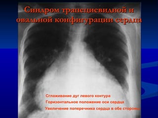 Синдром трапециевидной и овальной конфигурации сердца Сглаживание дуг левого контура Горизонтальное положение оси сердца Увеличение поперечника сердца в обе стороны 