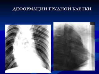 ДЕФОРМАЦИИ ГРУДНОЙ КЛЕТКИ 