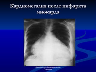 Кардиомегалия после инфаркта миокарда MeduMed.Org -  Медицина - Наше Призвание 