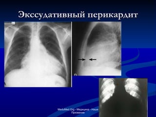 Экссудативный перикардит MeduMed.Org -  Медицина - Наше Призвание 