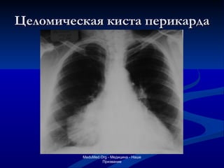 Целомическая киста перикарда MeduMed.Org -  Медицина - Наше Призвание 