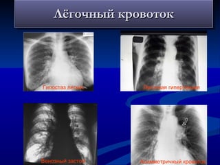 Лёгочный кровоток Гипостаз легких Легочная гипертензия Венозный застой Асимметричный кровоток 