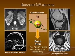 Источник МР-сигнала Вода Жир (т.е. практически все ткани тела человека) Ядра водорода Почки Вены головного мозга Колено Позвоночник  (поперечный срез) 