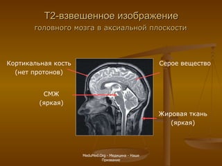 Т2-взвешенное изображение СМЖ (яркая) Жировая ткань (яркая) Кортикальная кость (нет протонов) Серое вещество головного мозга в аксиальной плоскости MeduMed.Org -  Медицина - Наше Призвание 