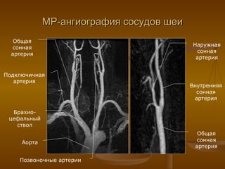 МР-ангиография сосудов шеи Аорта Брахио-цефальный ствол Общая сонная артерия Подключичная артерия Позвоночные артерии Общая сонная артерия Внутренняя сонная артерия Наружная сонная артерия 