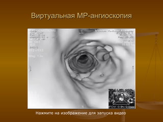 Виртуальная МР-ангиоскопия Нажмите на изображение для запуска видео 