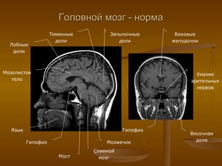 Головной мозг - норма Язык Спинной мозг Мозжечок Мост Гипофиз Лобные доли Теменные доли Мозолистое тело Затылочные доли Гипофиз Хиазма зрительных нервов Височная доля Боковые желудочки 