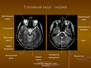 Головной мозг - норма Затылочная доля Червь мозжечка Ножки мозга Гиппокамп Зрительный нерв Височная доля Мозжечок Мост Четвертый желудочек Тройничный нерв Базилярная артерия MeduMed.Org -  Медицина - Наше Призвание 