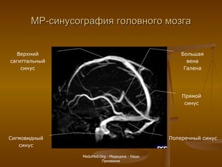 МР-синусография головного мозга Верхний сагиттальный синус Сигмовидный синус Поперечный синус Большая вена Галена Прямой синус MeduMed.Org -  Медицина - Наше Призвание 