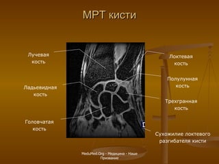 МРТ кисти Лучевая кость Локтевая кость Ладьевидная кость Полулунная кость Трехгранная кость Сухожилие локтевого разгибателя кисти Головчатая кость MeduMed.Org -  Медицина - Наше Призвание 
