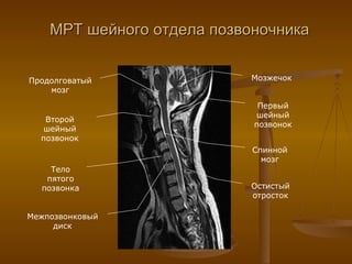 МРТ шейного отдела позвоночника Продолговатый мозг Спинной мозг Второй шейный позвонок Межпозвонковый диск Тело пятого позвонка Остистый отросток Мозжечок Первый шейный позвонок 
