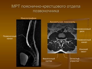МРТ пояснично-крестцового отдела позвоночника Миелография Аксиальная плоскость Позвоночный канал Остистый отросток Фасеточный сустав Межпозвонковый диск Позвоночный канал Конский хвост 