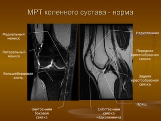 МРТ коленного сустава - норма Большеберцовая кость Задняя крестообразная связка Передняя крестообразная связка Надколенник Собственная связка надколенника Хрящ Латеральный мениск Медиальный мениск Внутренняя боковая связка 