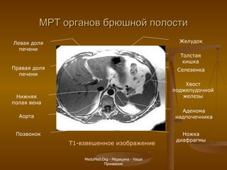 МРТ органов брюшной полости Т1-взвешенное изображение Правая доля печени Левая доля печени Позвонок Нижняя полая вена Аорта Ножка диафрагмы Желудок Селезенка Толстая кишка Аденома надпочечника Хвост поджелудочной железы MeduMed.Org -  Медицина - Наше Призвание 