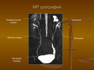 МР урография Мочевой пузырь Мочеточники Лоханка Чашечки Позвоночный канал 