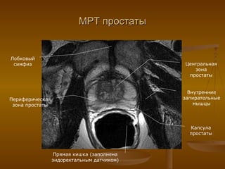 МРТ простаты Лобковый симфиз Периферическая зона простаты Прямая кишка (заполнена эндоректальным датчиком) Центральная зона простаты Внутренние запирательные мышцы Капсула простаты 