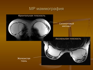 МР маммография Силиконовый имплант Железистая ткань Фронтальная плоскость Аксиальная плоскость 