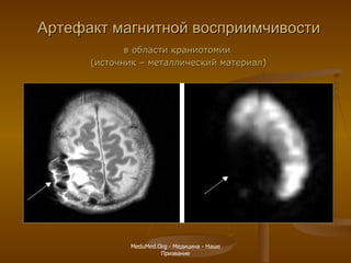 Артефакт магнитной восприимчивости в области краниотомии  (источник – металлический материал) MeduMed.Org -  Медицина - Наше Призвание 