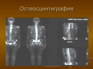 Остеосцинтиграфия 