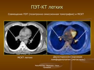 ПЭТ-КТ легких Совмещение ПЭТ (позитронно-эмиссионная томография) и МСКТ Двухсторонняя корневая  лимфаденопатия (метастазы) МСКТ легких MeduMed.Org -  Медицина - Наше Призвание 