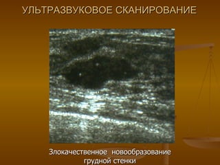 УЛЬТРАЗВУКОВОЕ СКАНИРОВАНИЕ Злокачественное  новообразование грудной стенки 