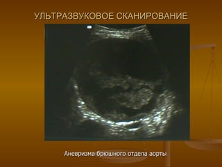 УЛЬТРАЗВУКОВОЕ СКАНИРОВАНИЕ Аневризма брюшного отдела аорты 