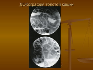 ДОКография толстой кишки 