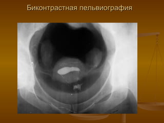 Биконтрастная пельвиография 