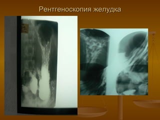 Рентгеноскопия желудка 