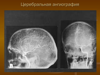 Церебральная ангиография 
