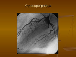 Коронарография 