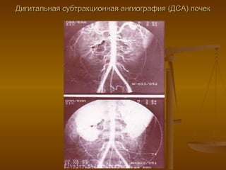 Дигитальная субтракционная ангиография (ДСА) почек 