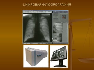 ЦИФРОВАЯ ФЛЮОРОГРАФИЯ 