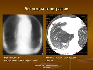 Эволюция томографии Рентгеновская  продольная томография легких Компьютерная томография  легких MeduMed.Org -  Медицина - Наше Призвание 