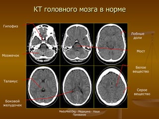 КТ головного мозга в норме Мозжечок Мост Гипофиз Таламус Боковой желудочек Белое вещество Серое вещество Лобные доли MeduMed.Org -  Медицина - Наше Призвание 