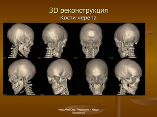 3 D   реконструкция Кости черепа MeduMed.Org -  Медицина - Наше Призвание 